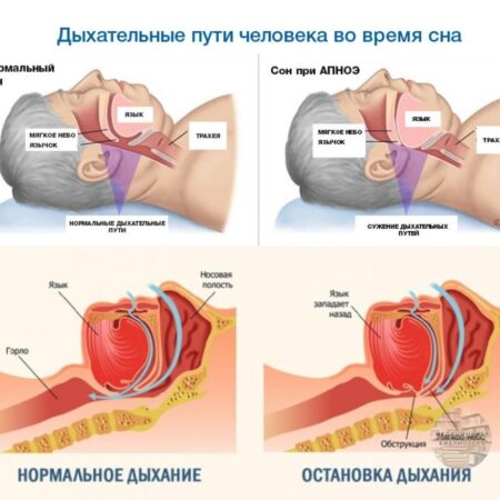 Глобальное потепление связано с ростом числа случаев апноэ сна