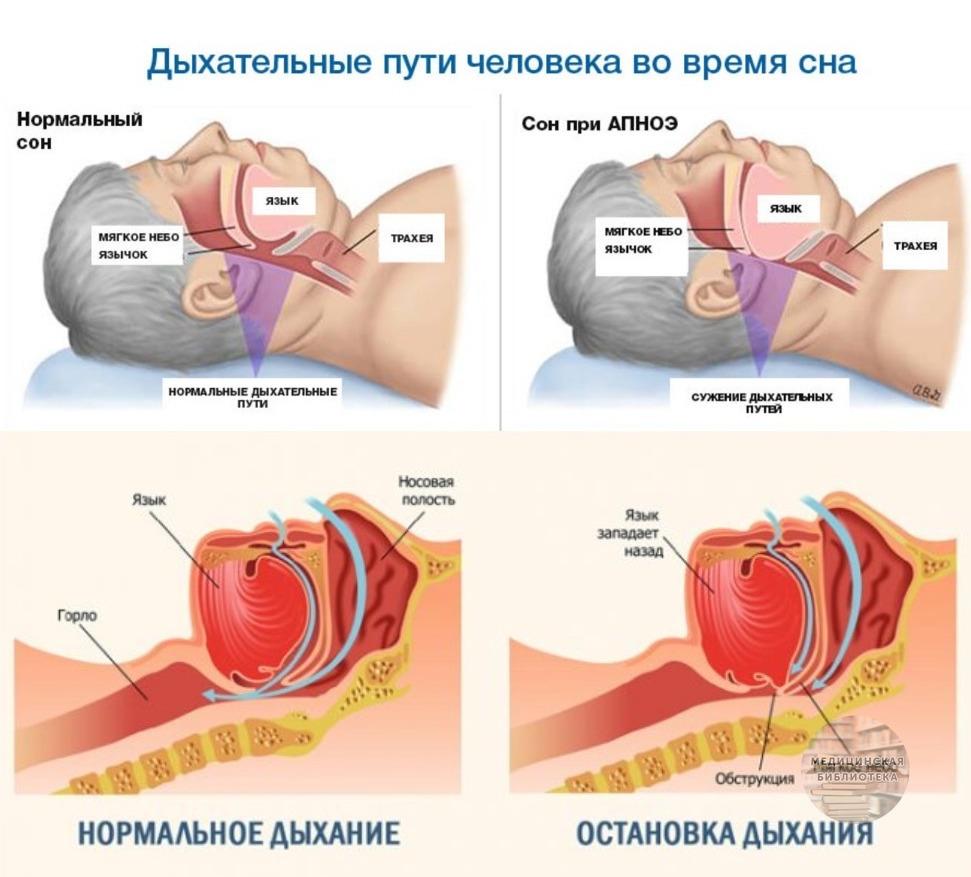 Preview Глобальное потепление связано с ростом числа случаев апноэ сна