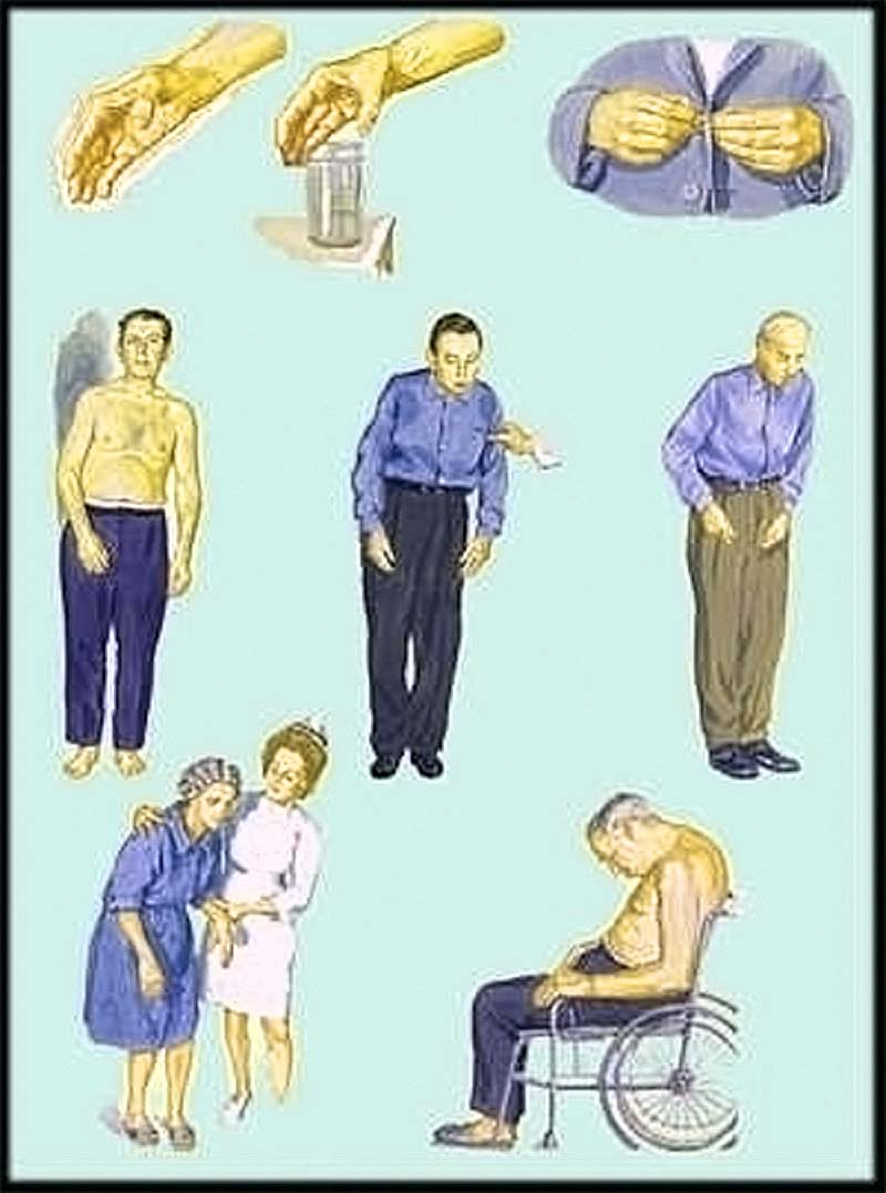 Preview Театр улучшает эмоциональное состояние при болезни Паркинсона