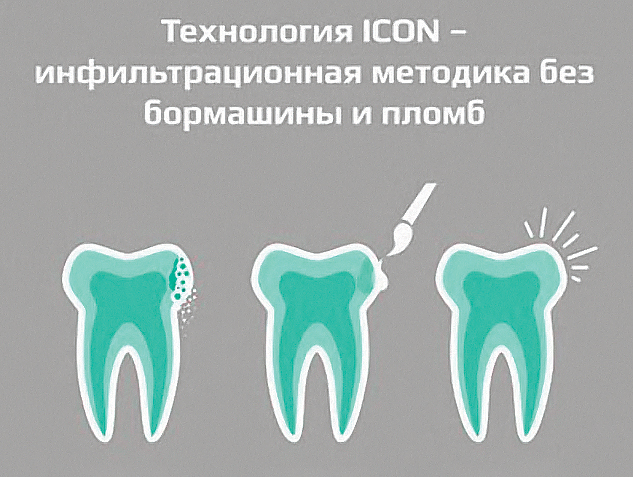 Preview Прорыв в стоматологии: Новый метод раннего предсказания кариеса