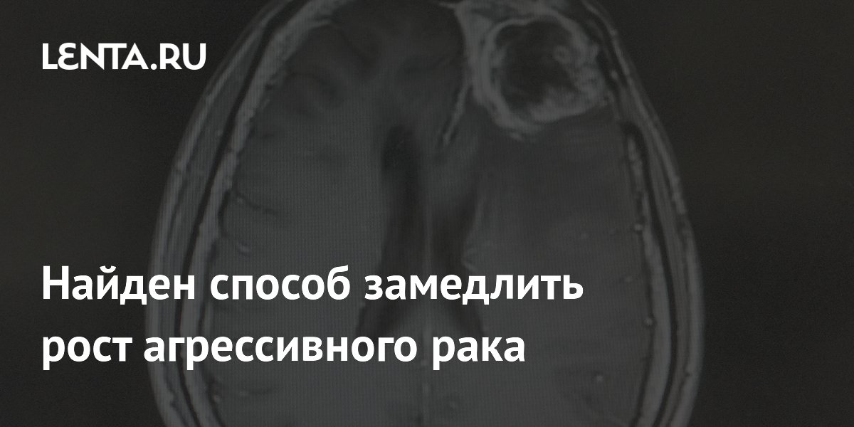 Preview Ученые нашли способ замедлить развитие агрессивной глиобластомы