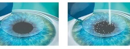 Лазерная коррекция зрения: безопасно для подростков