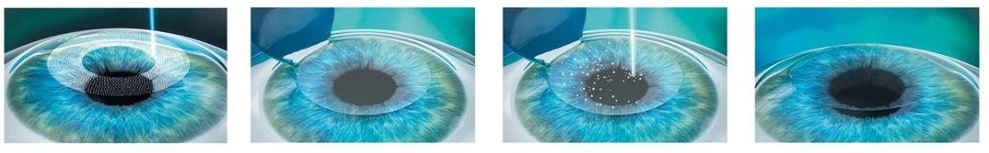 Preview Лазерная коррекция зрения: безопасно для подростков