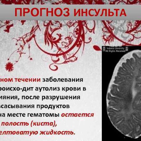 Природное соединение ДМТ: Неожиданная защита мозга при инсульте