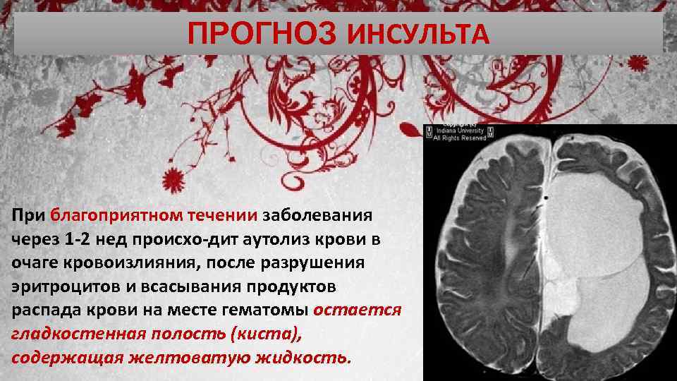 Preview Природное соединение ДМТ: Неожиданная защита мозга при инсульте