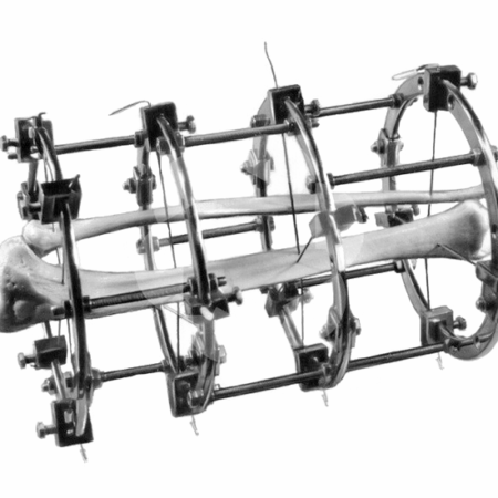 Устройство для мгновенного лечения переломов: Прорыв в костной хирургии