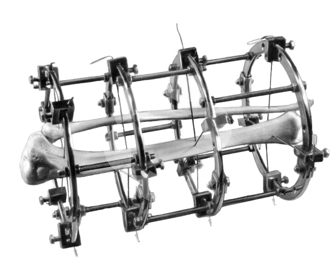 Preview Устройство для мгновенного лечения переломов: Прорыв в костной хирургии