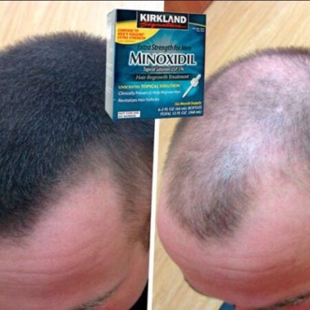 Эффективное средство против облысения: миноксидил со стевиозидом