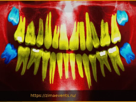 Удаление зубов мудрости: когда это необходимо