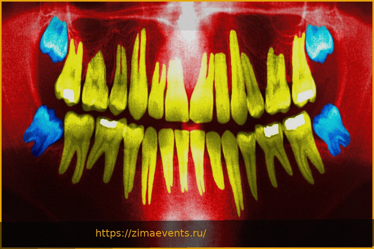 Preview Удаление зубов мудрости: когда это необходимо